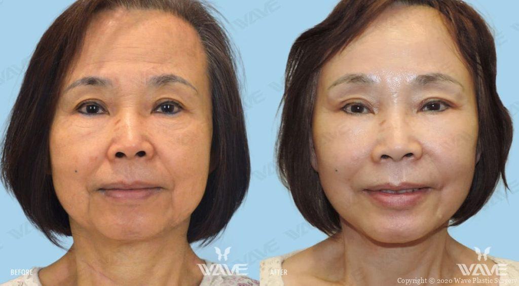 Endoscopic Brow Lift Surgery In Los Angeles Wave